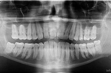 Панорамный снимок зубных рядов ( ОПТГ) со скидкой 40%